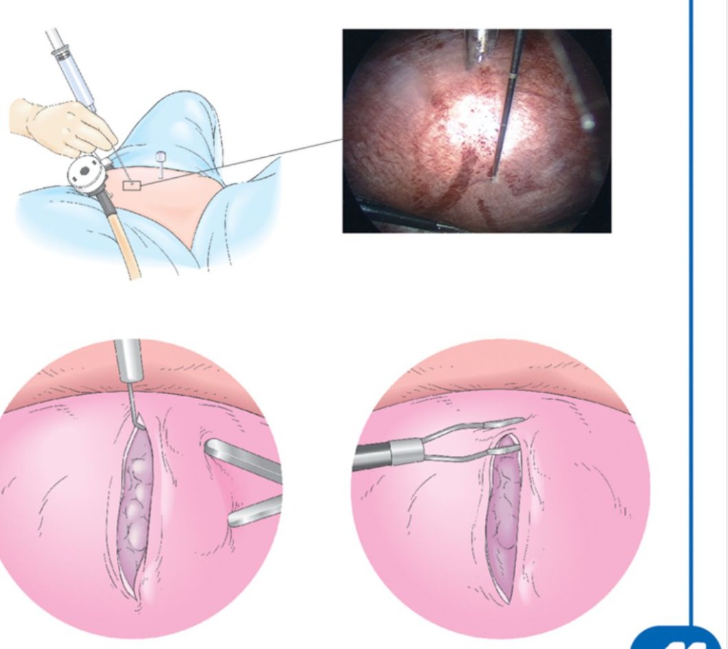 Laparoscopic Myomectomy Surgical Diagram