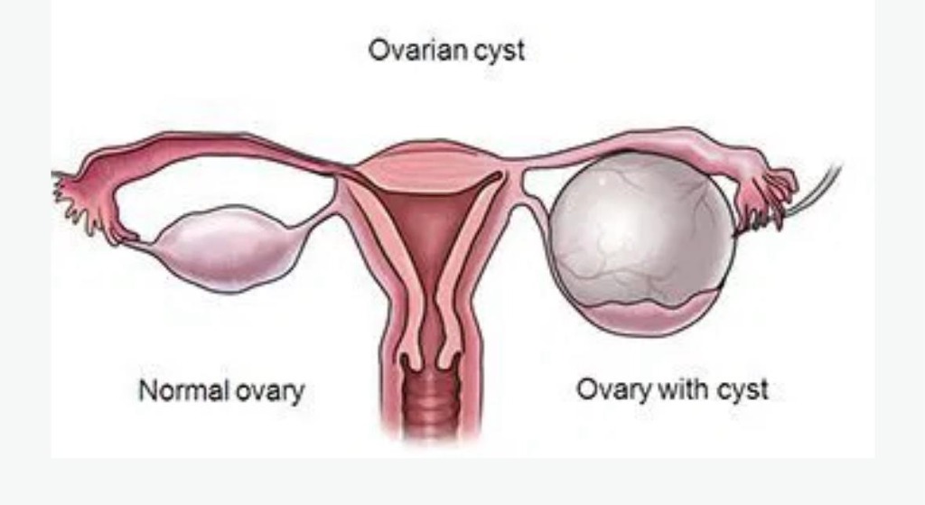 Understanding Ovarian Cysts