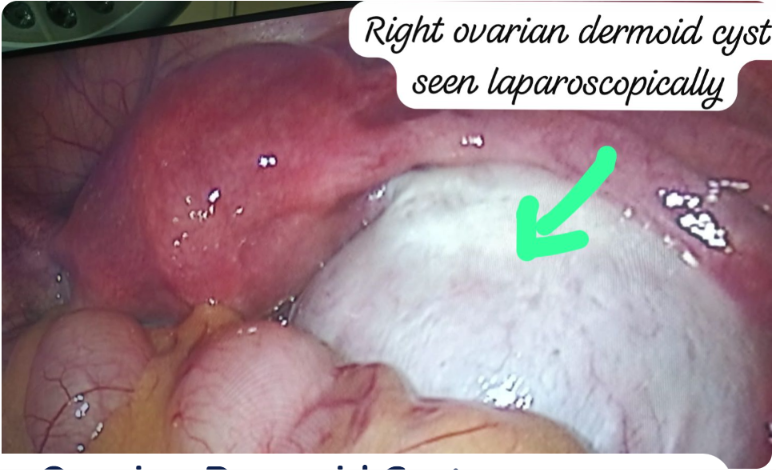 Ovarian Dermoid Cyst