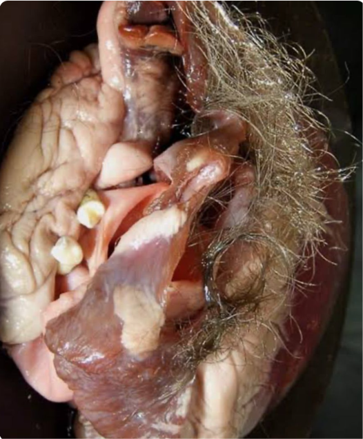Ovarian dermoid cyst gross specimen containing hair and dental tissue