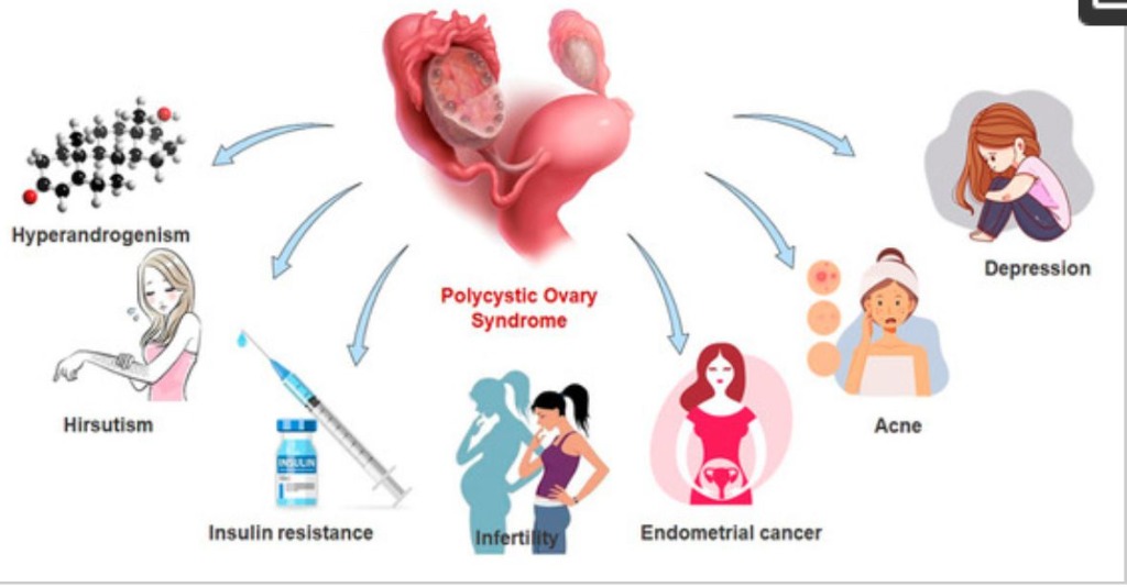 Understanding PCOS