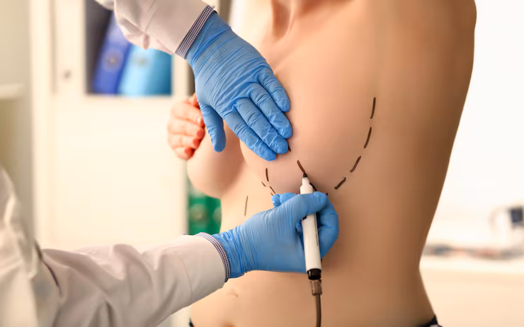 Breastsurgery at Namratha Hospitals