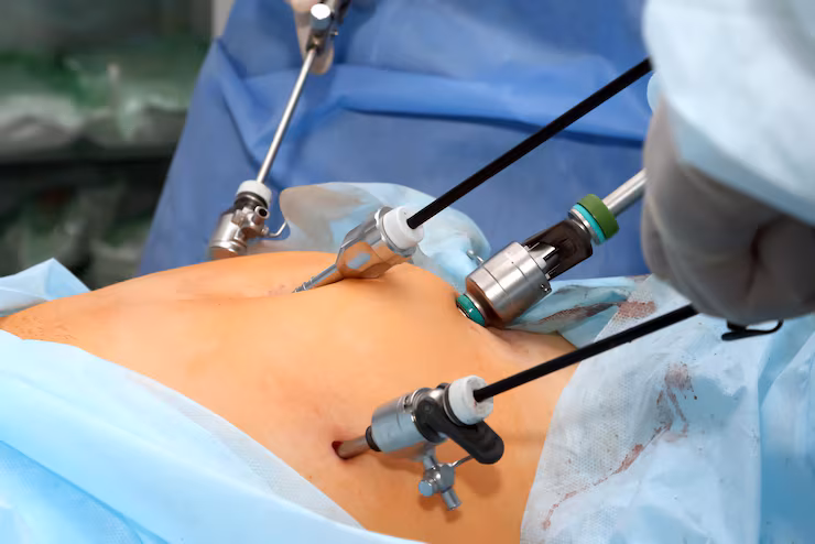 Totallaparoscopichysterectomy at Namratha Hospitals