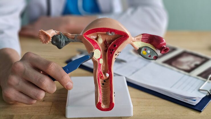 Hysteroscopicspetalresection at Namratha Hospitals
